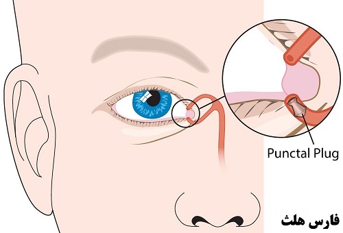 درمان خشکی چشم 
